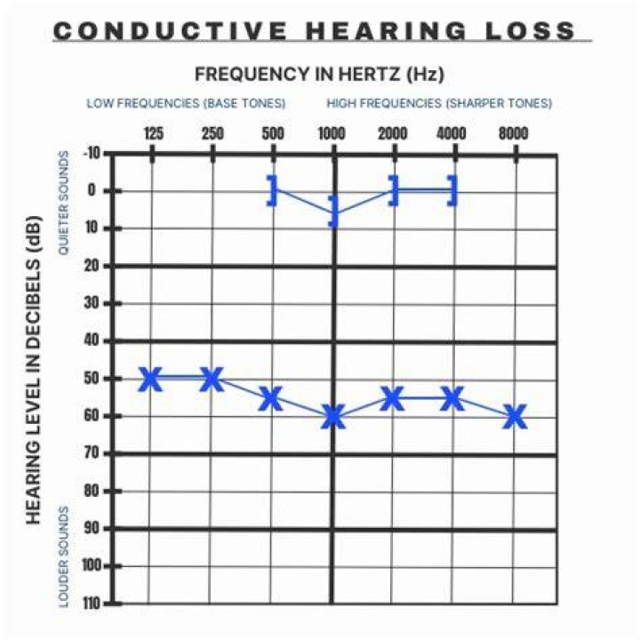 Does conductive hearing loss get better?