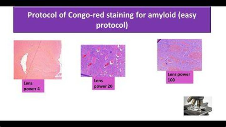 How does Congo red stain amyloid?