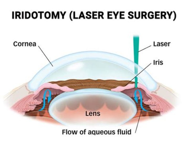 Should i get an iridotomy?