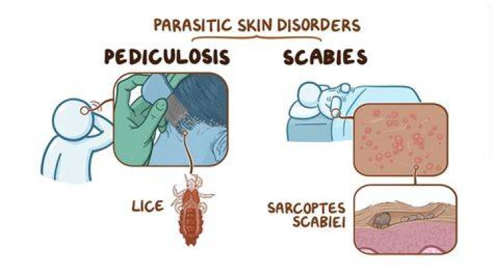 When does pediculosis start?